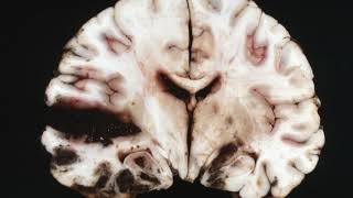 Difference Between Glioma and Glioblastoma [upl. by Mavilia]