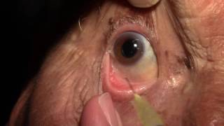 Right Intravitreal Injection of Eylea [upl. by Eigriv]