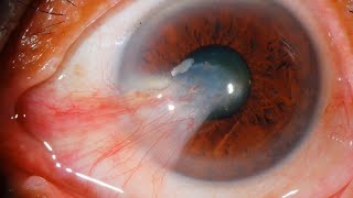 Pterygium Uncovering Causes and Symptomseyedoctor [upl. by Kerat291]