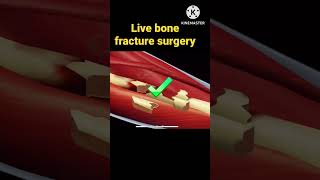 Live bone surgery treatment asmranimation animation shorts [upl. by Nuawtna]