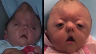 Tinley’s Story Diagnosed at Birth with Apert’s Syndrome 2013 [upl. by Mirisola]