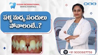 పళ్ళ మధ్య సందులు  How to Fill Gaps Between Teeth in Telugu  Ocean International Dental Hospitals [upl. by Essirehc]