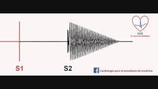 Soplo de la insuficiencia aórticaAortic Insufficiency murmur [upl. by Hcir]