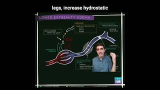 35 Lower Extremity Swelling How does changes in hydrostatic pressure cause lower extremity edema [upl. by Alita458]