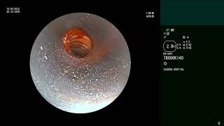 Complex Tracheal Stenosis  Rigid Bronchoscopy  CRE balloon dilation  Cryoablation [upl. by Li]