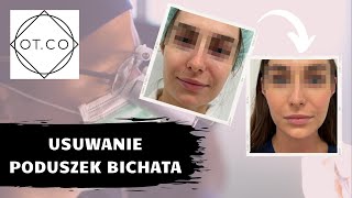 Usuwanie poduszek Bichata na czym polega zabieg jak się go wykonuje OTCO Clinic [upl. by Yrred728]