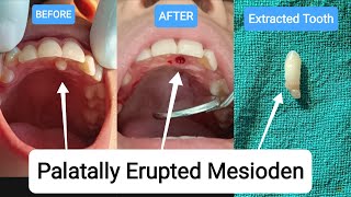 🇳🇵Extraction of Supernumerary Tooth Mesiodens Extra Tooth Exodontia Palatally Erupted nepal [upl. by Lledo]