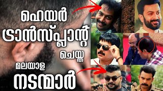 ഹെയർ ട്രാൻസ്പ്ലാന്റ് ചെയ്ത മലയാള നടന്മാർ  Hair Transplant  Hair Transplant malayalam [upl. by Irac333]