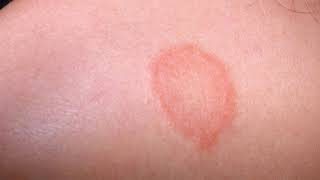 Difference Between Eczema and Ringworm [upl. by Menis632]