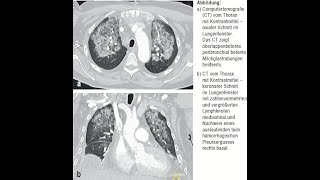 Daptomycin assoziierte eosinophile Pneumonitis [upl. by Winni545]