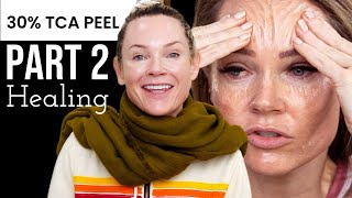 Part 2 TCA RECOVERY post care after chemical peel Before and After [upl. by Taimi]