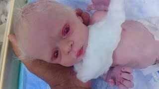 New born baby very small and preterm and low birth weight baby albino baby these baby came very rare [upl. by Diva626]