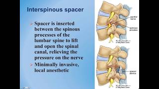 Lumbar Spinal Stenosis  Diagnosis and Treatment Options [upl. by Magdala529]