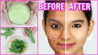 Remove Pimples Permanently 100 Results  DIY Face Wash Spot Treatment  Anaysa [upl. by Nanny]