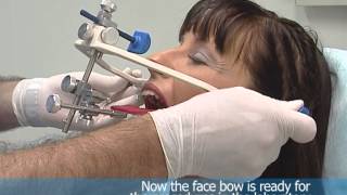 Asa Easy Bow  New transfer System ASA DENTAL [upl. by Panaggio]