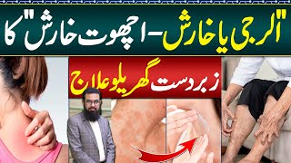 Scabies Home Treatment  Kharish Allergy Ka Ilaj  Psoriasis and Itching Treatment  Chambal Ka ilaj [upl. by Boys]