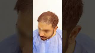 Incredible Hair Transplant Before amp After Dr Amit Kerure Hair Transplant Clinic Navi Mumbai [upl. by Adnawuj]