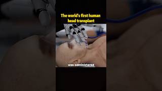 The world’s first human nead transplanthead change techical success youtube foryou fyp [upl. by Juieta]