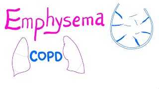 Emphysema  COPD  Pulmonary Medicine [upl. by Anyzratak79]