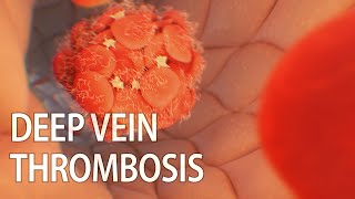 Venous thromboembolism  Deep vein thrombosis DVT  medical animation [upl. by Nerhtak]