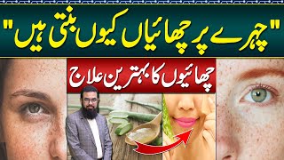 Melasma Treatment at Home  Melasma Cream and Melasma Home Remedies  Face Par Chaiyan Ka Ilaj [upl. by Lipinski]