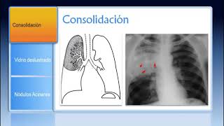 Patrones Pulmonares en Radiología y TC [upl. by Jennine]