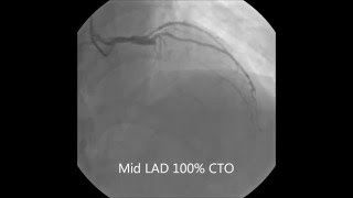 LAD CTO PCI [upl. by Zumwalt]