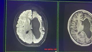 Crisis convulsivas en niños epilepsia por infarto cerebral perinatal [upl. by Naesyar97]