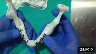 Edentulous Maxilla and Mandible Reconstruction  3D Printed Subperiosteal Implants [upl. by Ymmik]