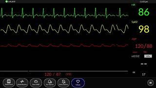 Simulated Patient Monitor  Normal Sinus Rhythm [upl. by Natal]