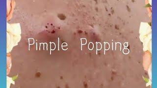 Pimple amp Blackheads Popping  39 [upl. by Nilam799]