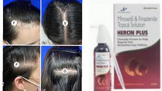 HERCIN PLUS Topical Solution Minoxidil amp Finasteride Topical Solution [upl. by Cleti679]