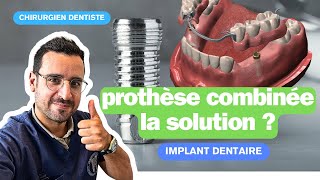 Dents mobiles  les implants dentaire pour stabiliser un appareil [upl. by Bannerman311]