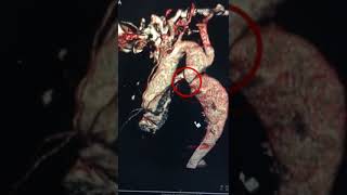 Implantación de stent en coartación nórtica Parte 1  Intervencionismo [upl. by Guidotti505]