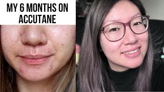 My Accutane Journey Why Accutane Side Effects Skincare Routine and Tips [upl. by Benedic]