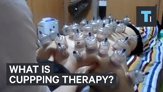 What is cupping therapy [upl. by Sophie]