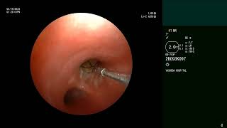 Airway foreign body removal  Bronchoscopy [upl. by Attenna]