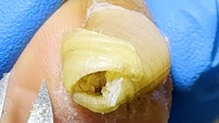 Toenails are severely curled be careful to separate the ingrown toenails【Xue Yidao】 [upl. by Nylrac590]