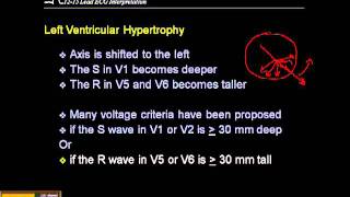 1215 Lead ECG Ventricular Hypertrophy [upl. by Haelam]