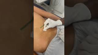 Quadratus lumborum QL dry needling [upl. by Nyrhtak611]