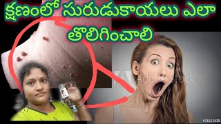 క్షణంలో సురుడుకాయలు ఎలా తొలిగించాలిHOW TO REMOVE WARTS IN A MINUTEBY BEAUTICIAN SRIDEVI [upl. by Jobi]