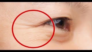 Quitar las arrugas delos ojos  Mascarilla Casera Natural [upl. by Sadnak]