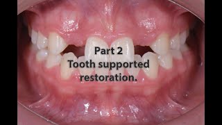 management of missed lateral tooth supported restoration [upl. by Aivatco890]