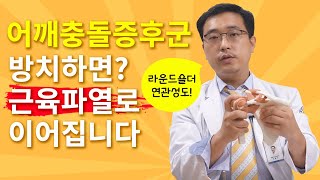 충돌증후군 증상 현대인의 80가 주의해야 하는 이유 뚝뚝거리는 어깨소리 주의 [upl. by Ynneh]