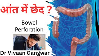 Bowel Perforation  Intestinal Perforations  Bowel Perforation Causes  Intestinal Obstruction [upl. by Pinter]