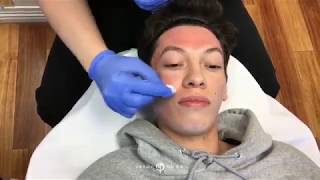 DEEP PHENOL TCA REVEPEEL CHEMICAL PEELING HELPS IMPROVE ACNE SCARS AND PORES  DR JASON EMER [upl. by Nolaj88]