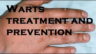 Warts treatment and prevention [upl. by Ayotol]