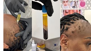 TRANSFORMING MY HAIRLINE PRP TREATMENT [upl. by Mohr870]