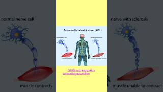 Amyotrophic lateral sclerosis neuroscience amyotrophiclateralsclerosis brainscience [upl. by Eibbed]