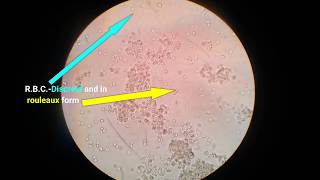 Stool analysisLab diagnosis of dysentery bacillary dysentery [upl. by Itoc]